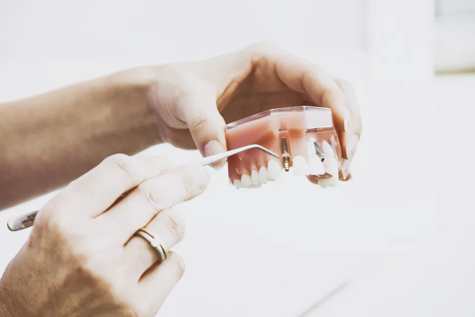 Diş modeli üzerinde implant gösterimi